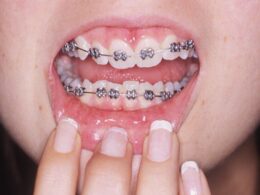 Why Adults Can Also Consider Getting Braces