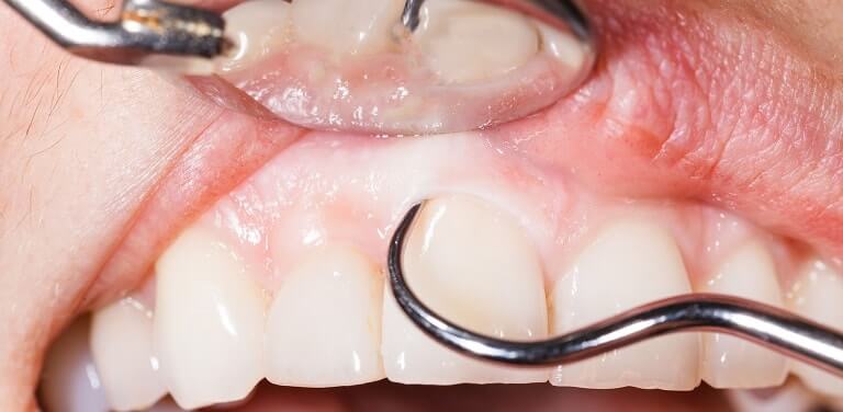 When should you have professional gum line scaling done?